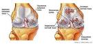 Синовиальная киста голеностопного сустава